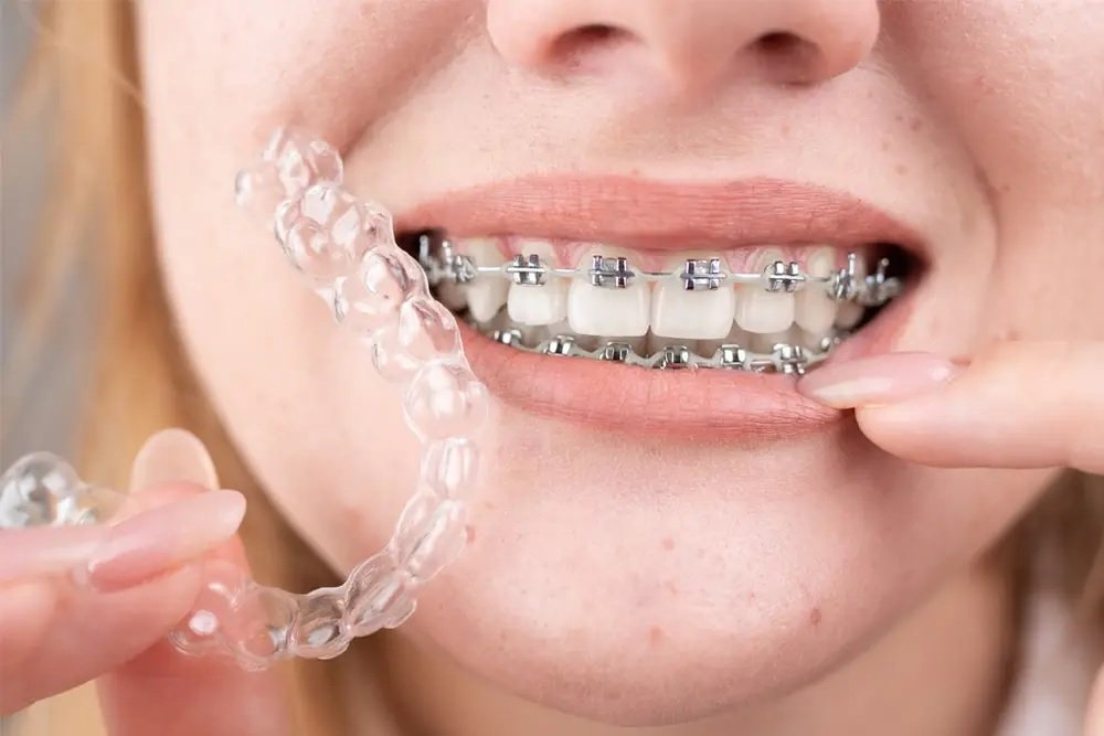 Invisalign Benefits Vs. Traditional Braces for Your Best Smile