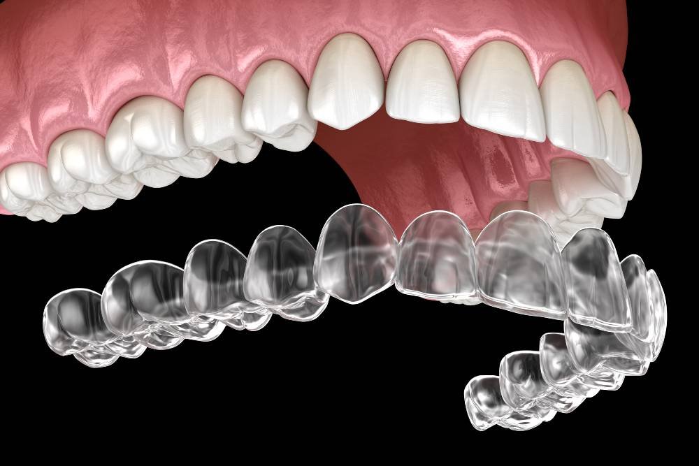Invisalign Results Longevity Requires Consistent Retention for Life